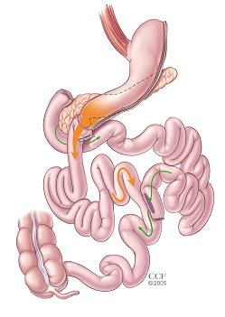 Biliopancreatic Diversion with Duodenal Switch (BPD/DS) surgical illustration