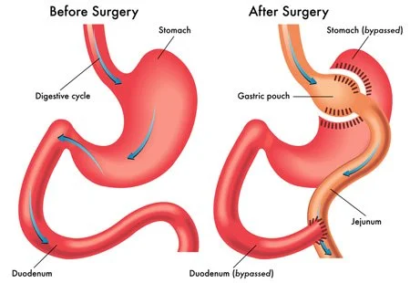 Gastric Bypass surgical illustration