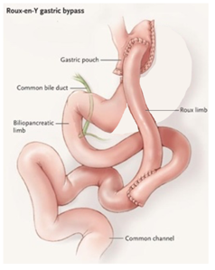 Gastric sleeve revision surgery illustration