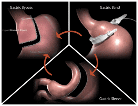 Revision weight loss surgery illustration