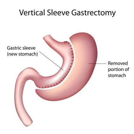 Sleeve Gastrectomy surgical illustration