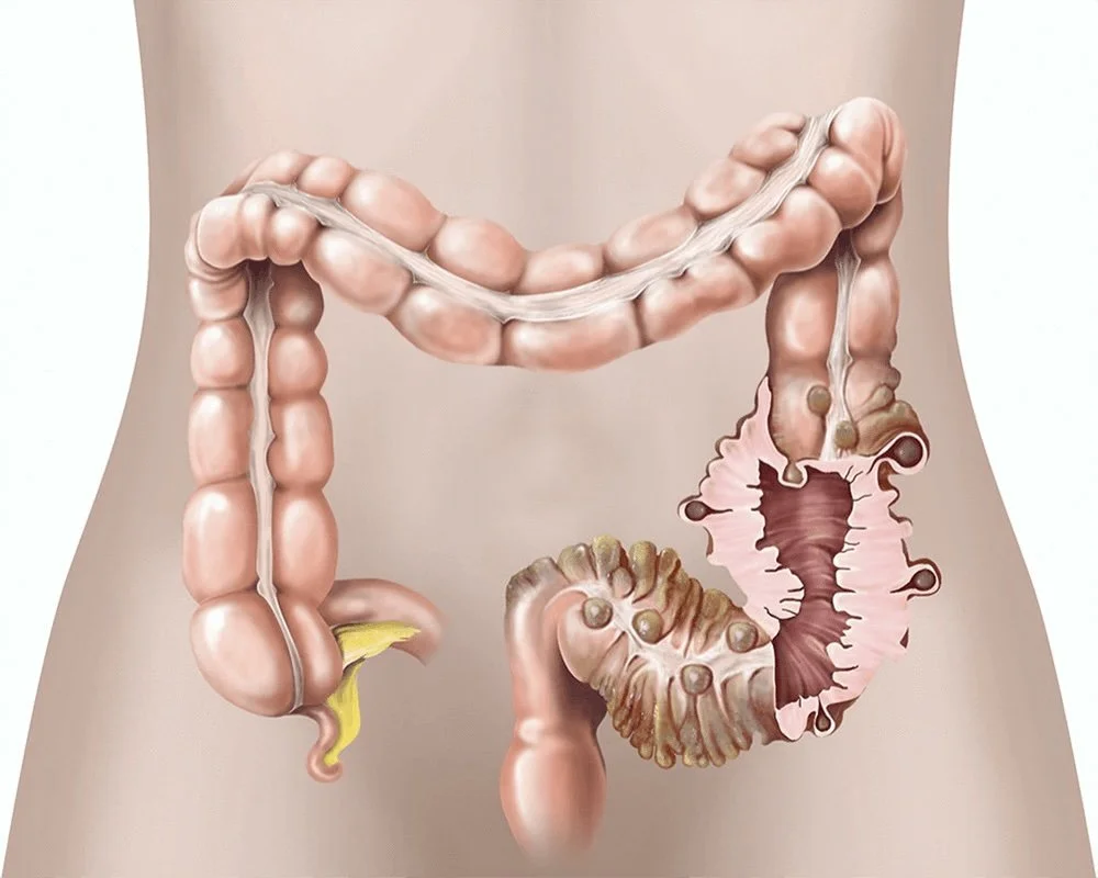 When Is Surgery Needed for Diverticulitis?