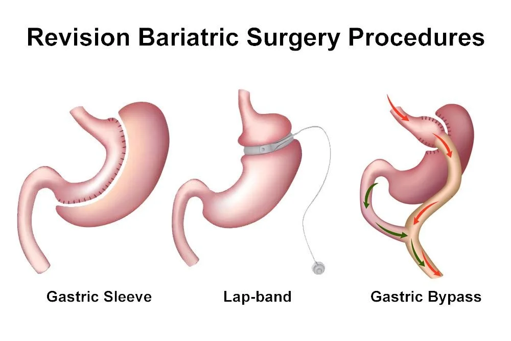 Revision Weight Loss Surgery