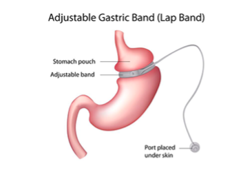 Lap-Band revision surgery illustration