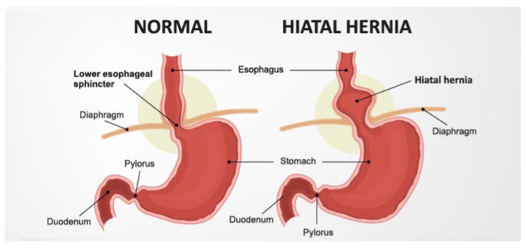Revision weight loss surgery options